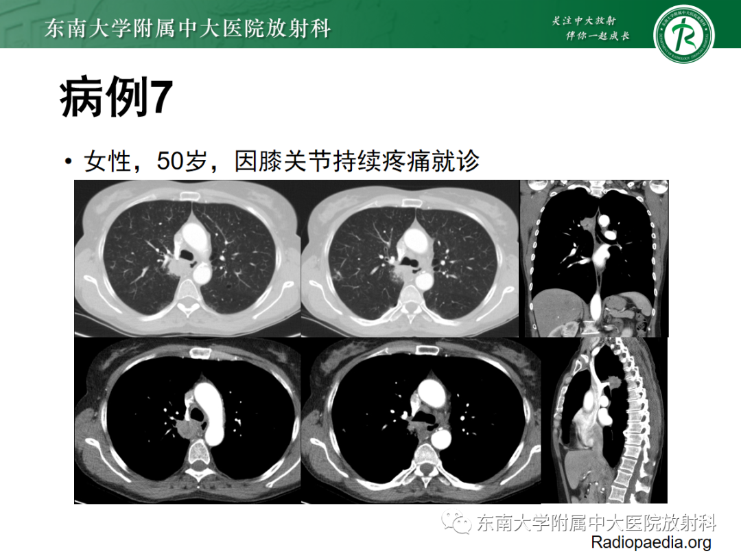 影像PPT - 【PPT】小细胞肺癌-27 影像PPT - 【PPT】小细胞肺癌-27