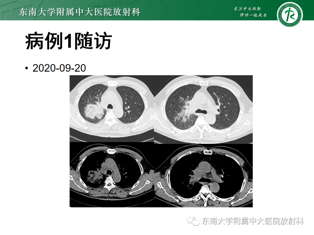 影像PPT - 【PPT】小细胞肺癌-29 影像PPT - 【PPT】小细胞肺癌-29