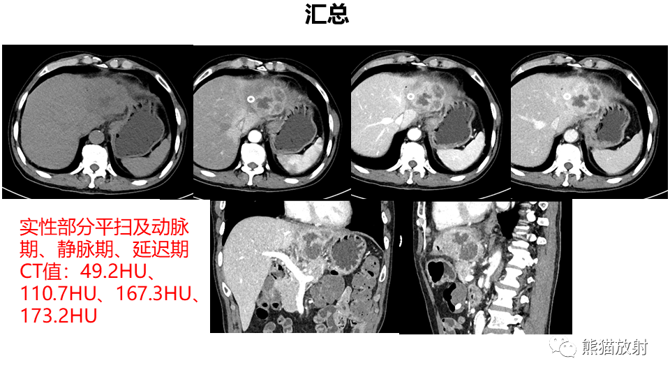 影像PPT - 【PPT】肝内胆管细胞癌 VS 肝脓肿-22