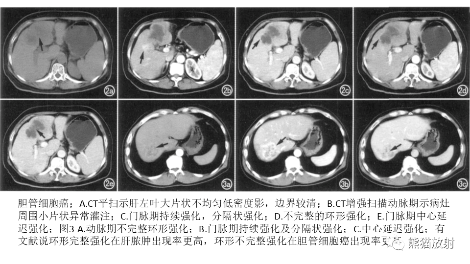 影像PPT - 【PPT】肝内胆管细胞癌 VS 肝脓肿-30