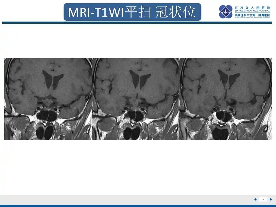 影像PPT - 【PPT】垂体细胞瘤-4