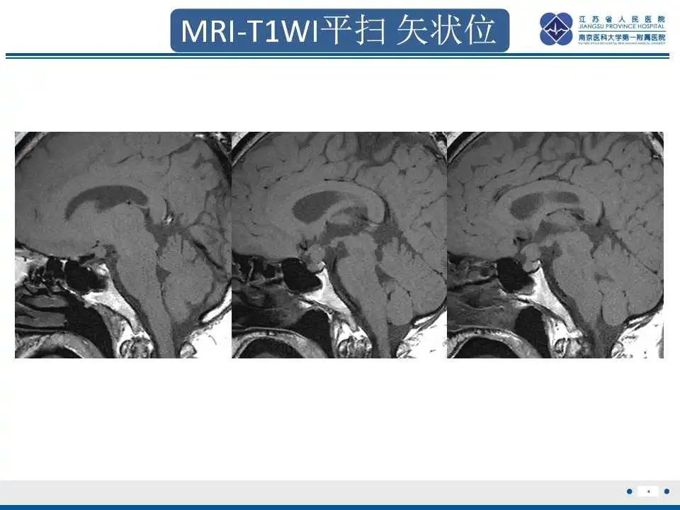 影像PPT - 【PPT】垂体细胞瘤-5