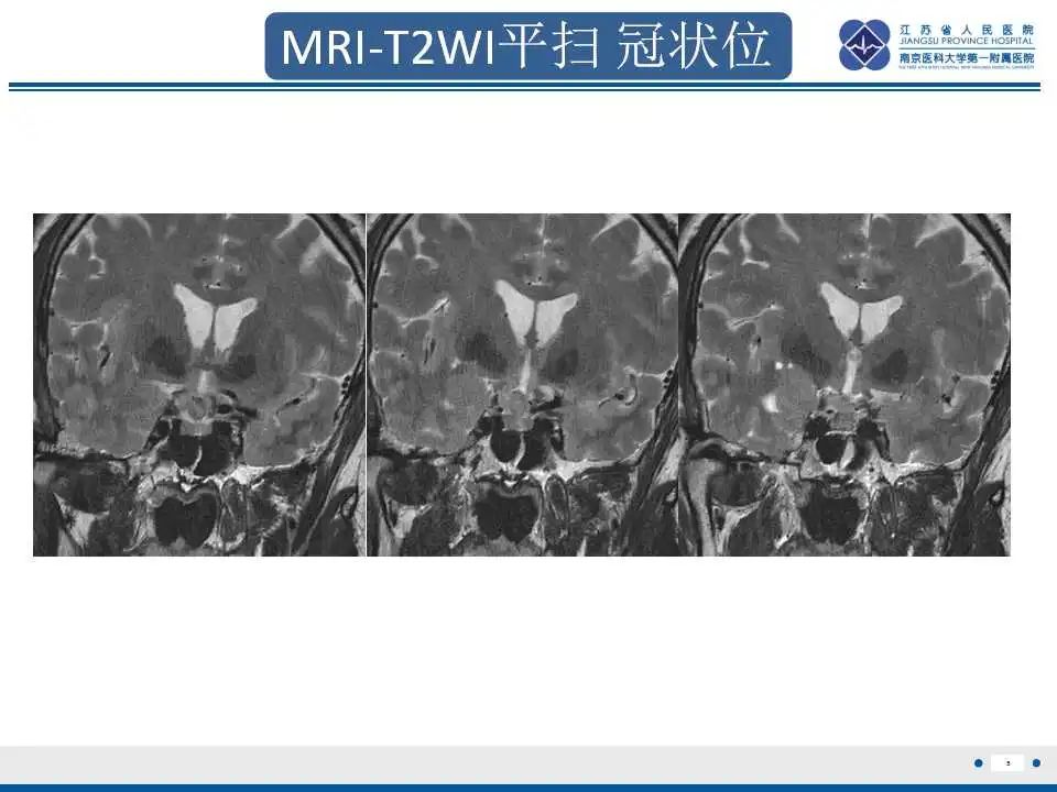 影像PPT - 【PPT】垂体细胞瘤-6
