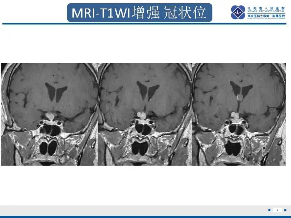 影像PPT - 【PPT】垂体细胞瘤-7