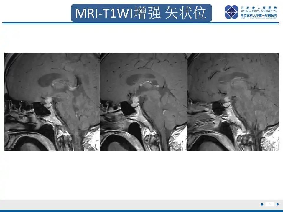 影像PPT - 【PPT】垂体细胞瘤-8