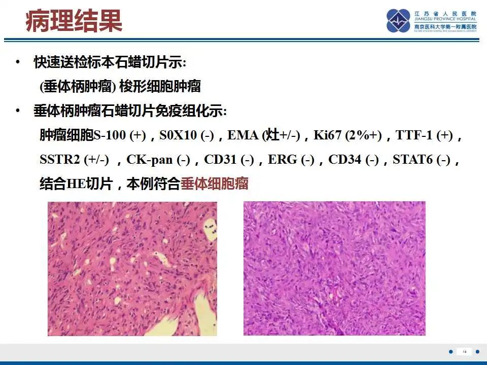 影像PPT - 【PPT】垂体细胞瘤-19