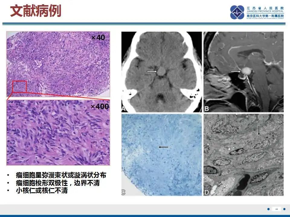 影像PPT - 【PPT】垂体细胞瘤-23