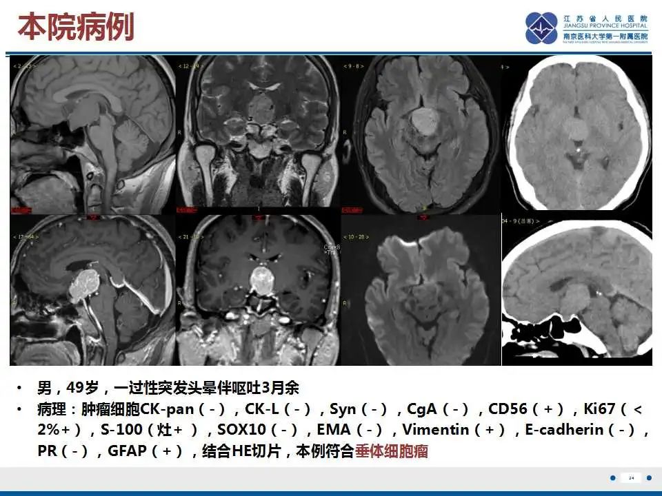 影像PPT - 【PPT】垂体细胞瘤-25