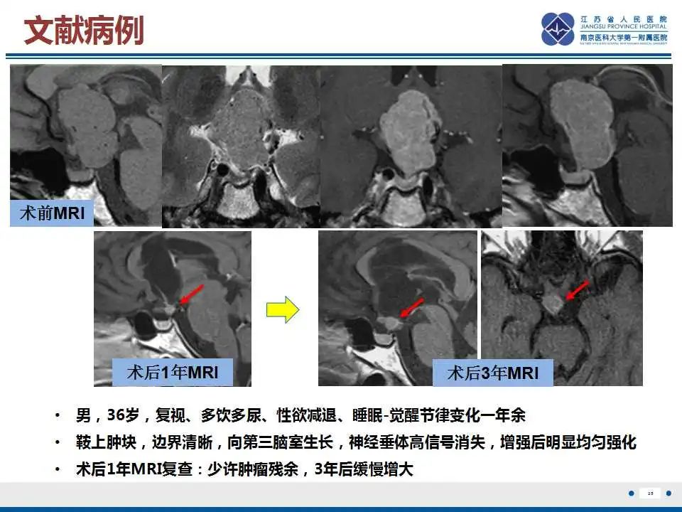影像PPT - 【PPT】垂体细胞瘤-26