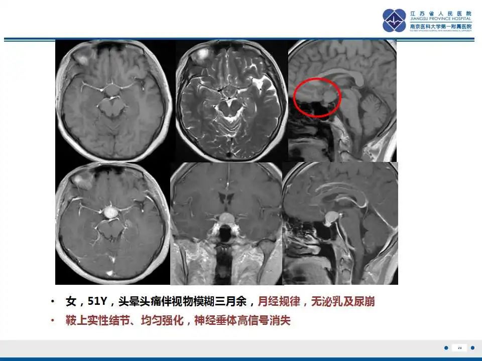 影像PPT - 【PPT】垂体细胞瘤-30