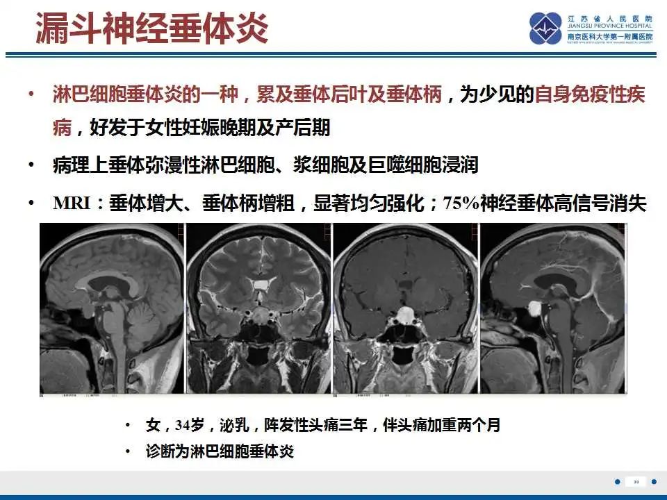 影像PPT - 【PPT】垂体细胞瘤-31