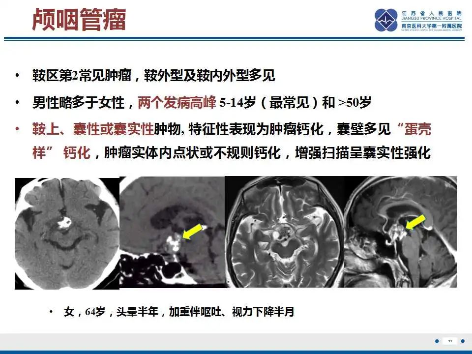 影像PPT - 【PPT】垂体细胞瘤-33