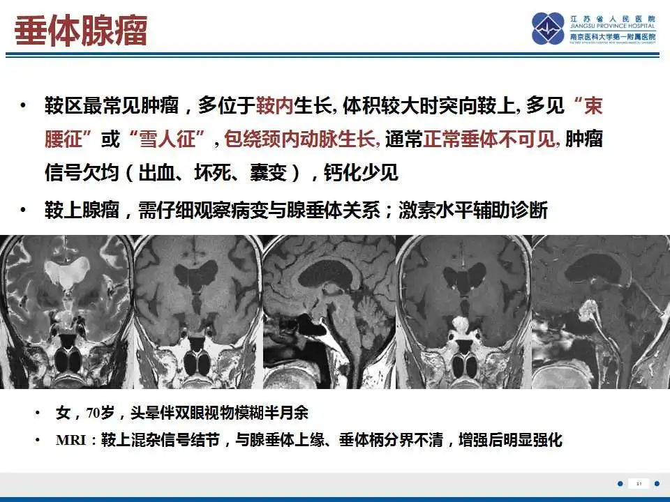 影像PPT - 【PPT】垂体细胞瘤-32