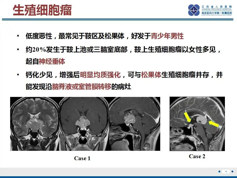 影像PPT - 【PPT】垂体细胞瘤-34