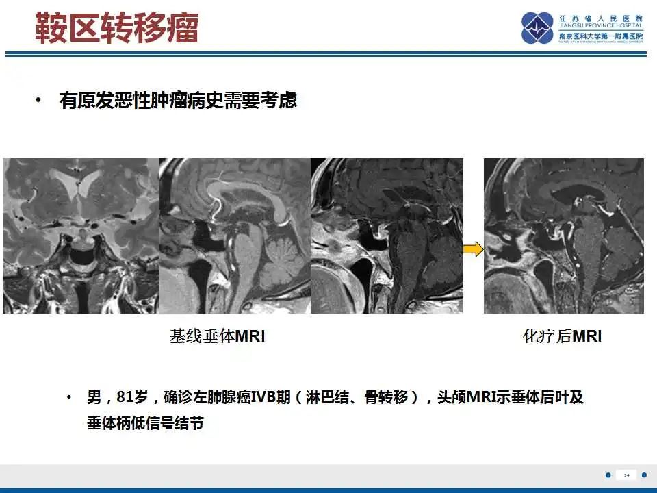 影像PPT - 【PPT】垂体细胞瘤-35