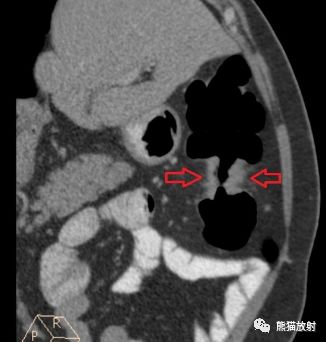 影像PPT - “苹果核征”,这个征象提示啥?-7 影像PPT - “苹果核征”,这个征象提示啥?-7