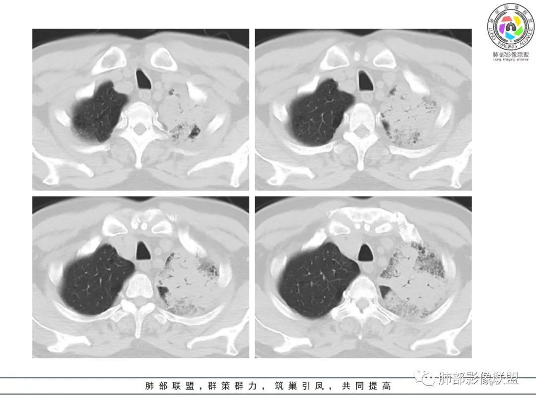 影像PPT - 【病例】鹦鹉热衣原体感染肺炎1例CT-3 影像PPT - 【病例】鹦鹉热衣原体感染肺炎1例CT-3