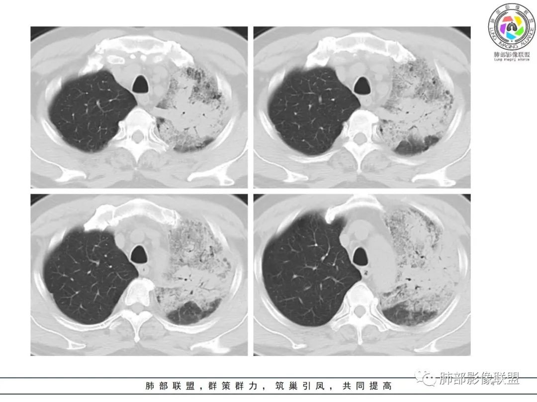 影像PPT - 【病例】鹦鹉热衣原体感染肺炎1例CT-4 影像PPT - 【病例】鹦鹉热衣原体感染肺炎1例CT-4