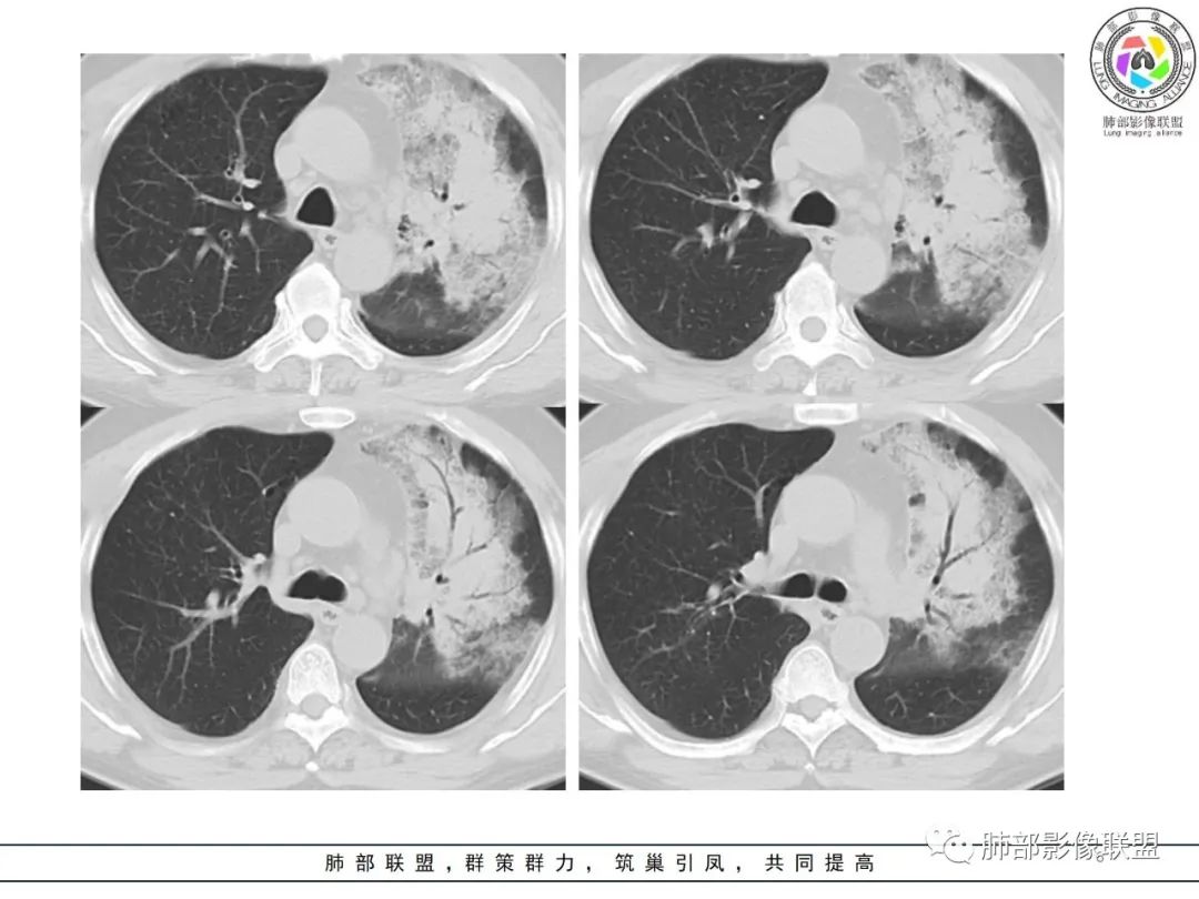 影像PPT - 【病例】鹦鹉热衣原体感染肺炎1例CT-6 影像PPT - 【病例】鹦鹉热衣原体感染肺炎1例CT-6