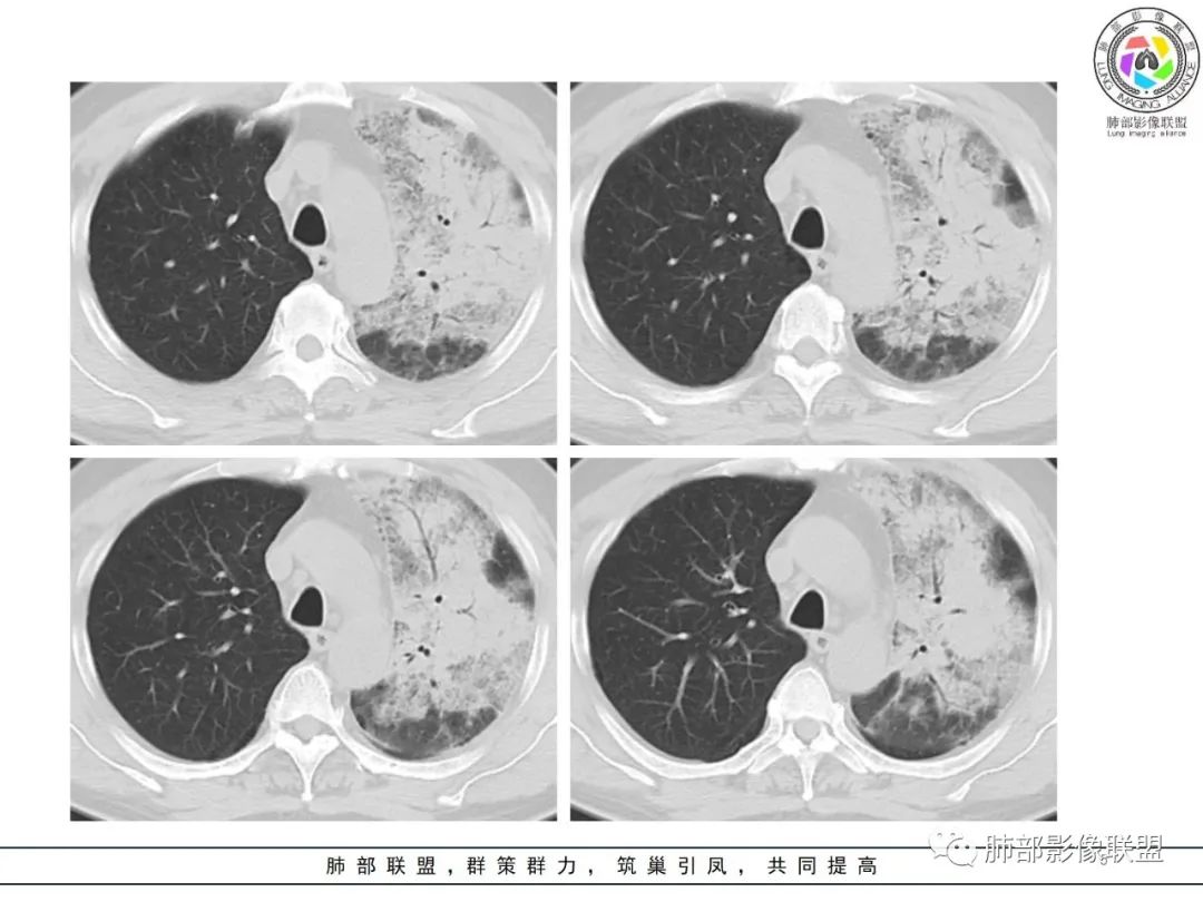 影像PPT - 【病例】鹦鹉热衣原体感染肺炎1例CT-5 影像PPT - 【病例】鹦鹉热衣原体感染肺炎1例CT-5