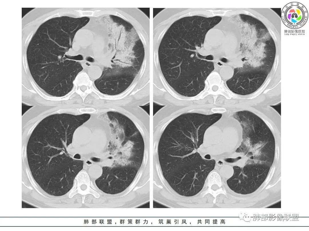 影像PPT - 【病例】鹦鹉热衣原体感染肺炎1例CT-7 影像PPT - 【病例】鹦鹉热衣原体感染肺炎1例CT-7