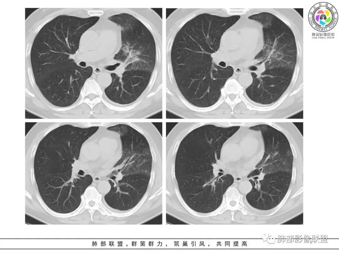 影像PPT - 【病例】鹦鹉热衣原体感染肺炎1例CT-8 影像PPT - 【病例】鹦鹉热衣原体感染肺炎1例CT-8