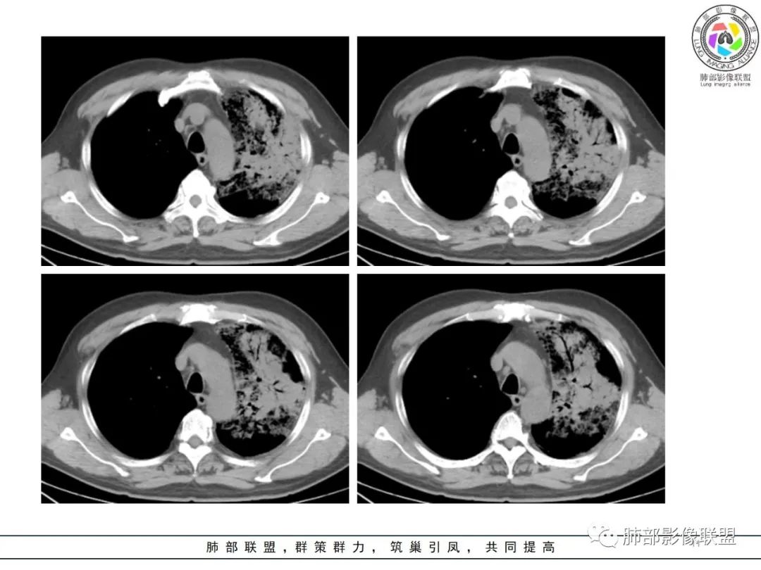 影像PPT - 【病例】鹦鹉热衣原体感染肺炎1例CT-11 影像PPT - 【病例】鹦鹉热衣原体感染肺炎1例CT-11