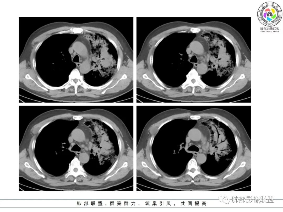 影像PPT - 【病例】鹦鹉热衣原体感染肺炎1例CT-12 影像PPT - 【病例】鹦鹉热衣原体感染肺炎1例CT-12