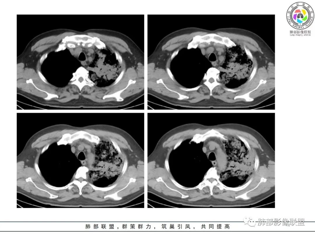 影像PPT - 【病例】鹦鹉热衣原体感染肺炎1例CT-10 影像PPT - 【病例】鹦鹉热衣原体感染肺炎1例CT-10