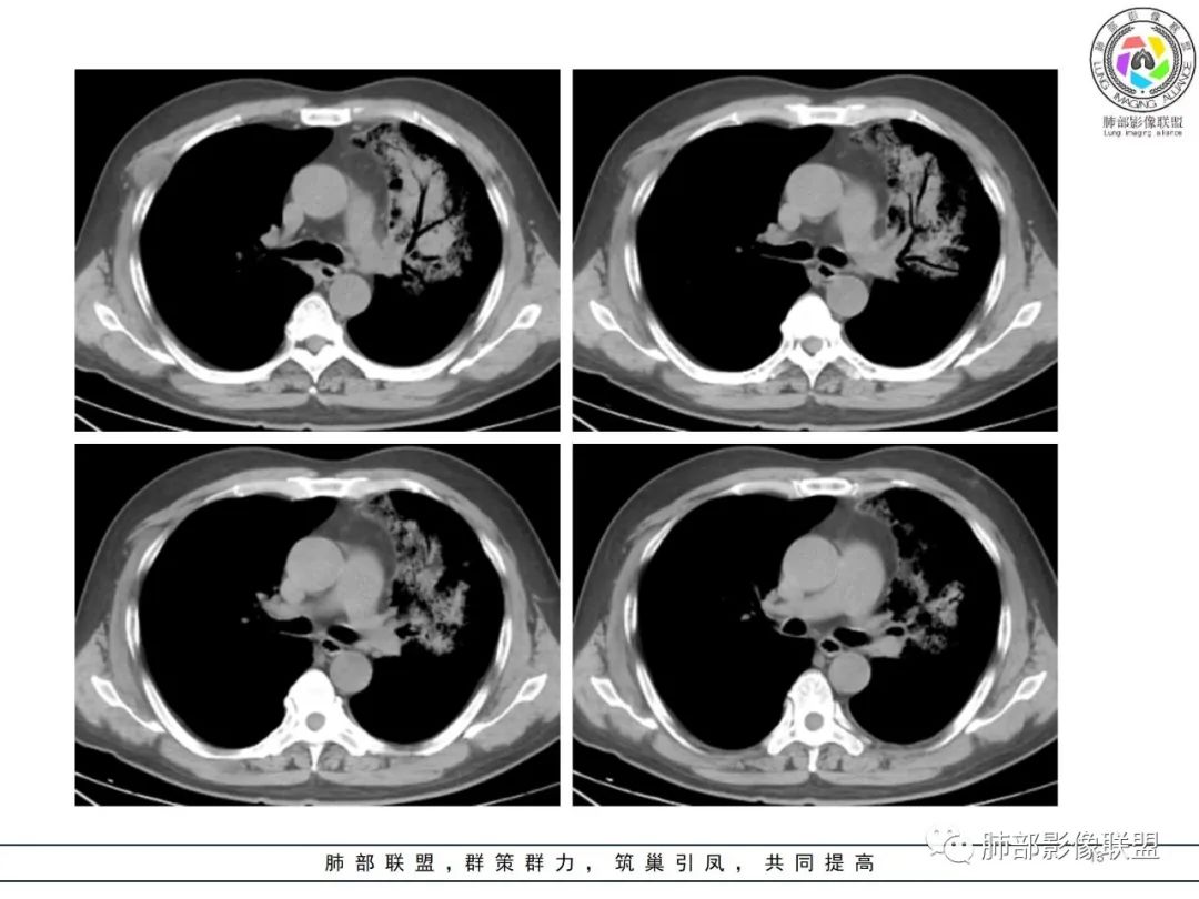 影像PPT - 【病例】鹦鹉热衣原体感染肺炎1例CT-13 影像PPT - 【病例】鹦鹉热衣原体感染肺炎1例CT-13
