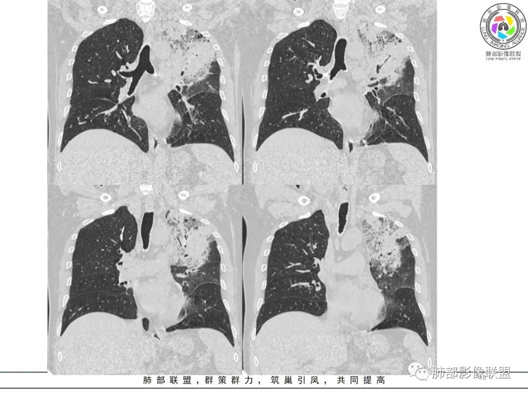 影像PPT - 【病例】鹦鹉热衣原体感染肺炎1例CT-15 影像PPT - 【病例】鹦鹉热衣原体感染肺炎1例CT-15
