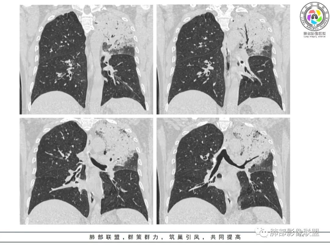 影像PPT - 【病例】鹦鹉热衣原体感染肺炎1例CT-14 影像PPT - 【病例】鹦鹉热衣原体感染肺炎1例CT-14