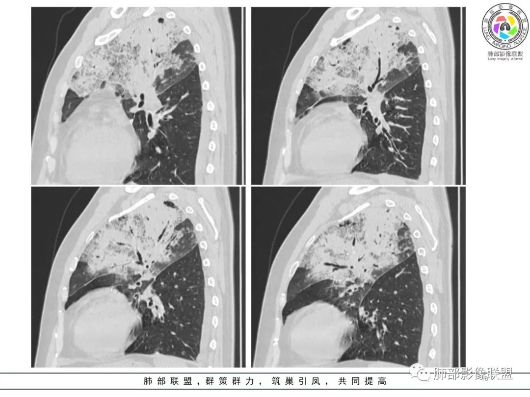 影像PPT - 【病例】鹦鹉热衣原体感染肺炎1例CT-16 影像PPT - 【病例】鹦鹉热衣原体感染肺炎1例CT-16