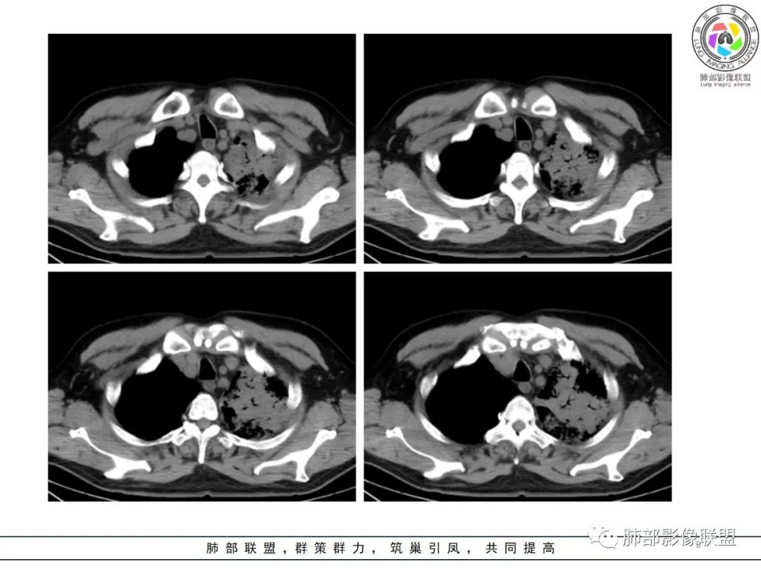 影像PPT - 【病例】鹦鹉热衣原体感染肺炎1例CT-9 影像PPT - 【病例】鹦鹉热衣原体感染肺炎1例CT-9