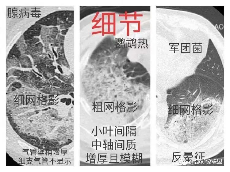 影像PPT - 【病例】鹦鹉热衣原体感染肺炎1例CT-23 影像PPT - 【病例】鹦鹉热衣原体感染肺炎1例CT-23