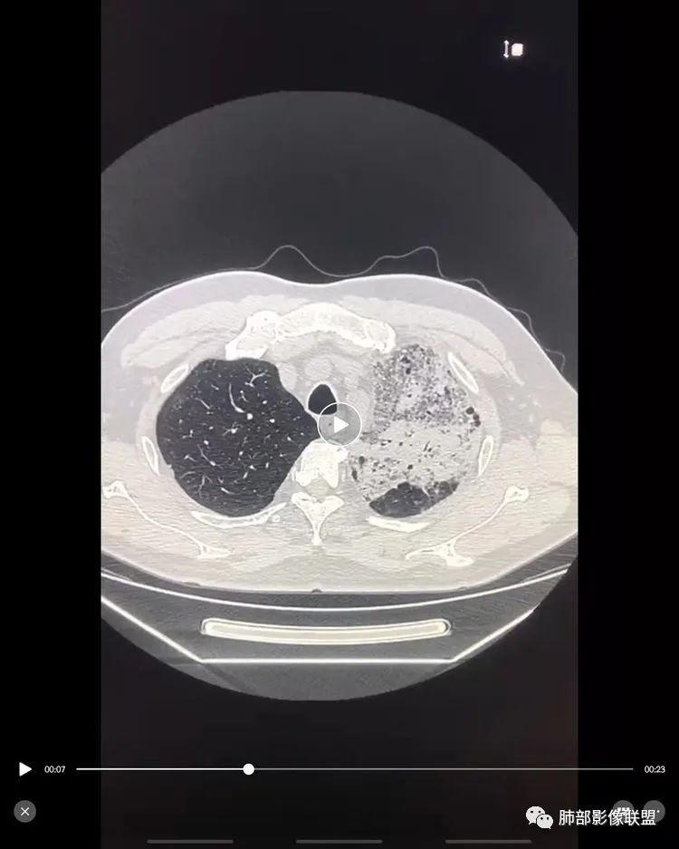 影像PPT - 【病例】鹦鹉热衣原体感染肺炎1例CT-24 影像PPT - 【病例】鹦鹉热衣原体感染肺炎1例CT-24