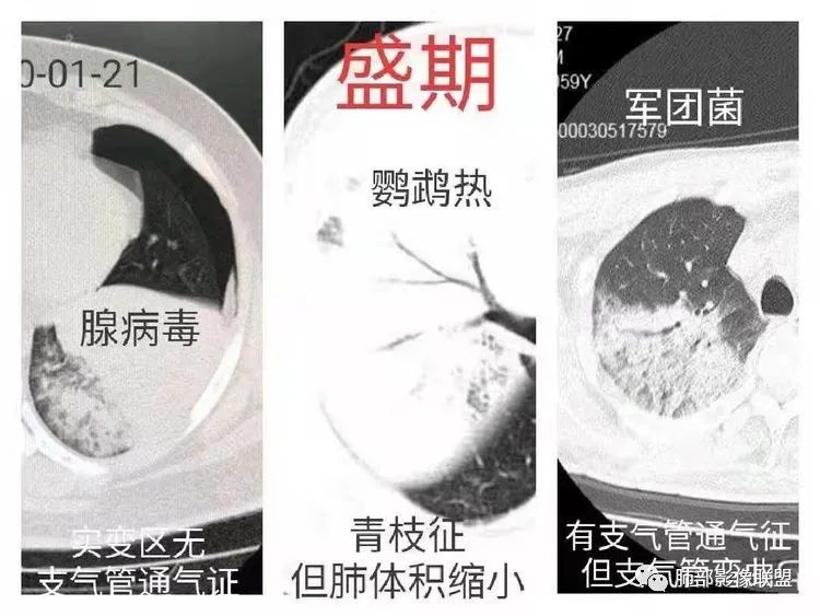 影像PPT - 【病例】鹦鹉热衣原体感染肺炎1例CT-25 影像PPT - 【病例】鹦鹉热衣原体感染肺炎1例CT-25