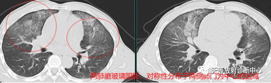 影像PPT - 抗中性粒细胞胞质抗体(ANCA)相关血管炎肺出血-13 影像PPT - 抗中性粒细胞胞质抗体(ANCA)相关血管炎肺出血-13