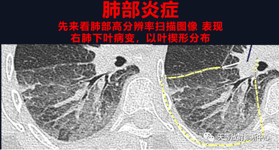 影像PPT - 抗中性粒细胞胞质抗体(ANCA)相关血管炎肺出血-14 影像PPT - 抗中性粒细胞胞质抗体(ANCA)相关血管炎肺出血-14