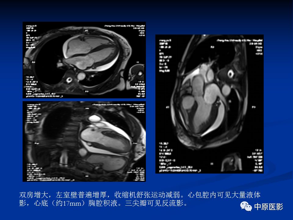 影像PPT - 【病例】心肌淀粉样变性1例MR影像-3