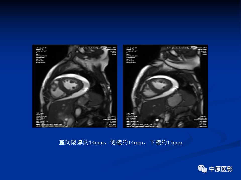 影像PPT - 【病例】心肌淀粉样变性1例MR影像-4