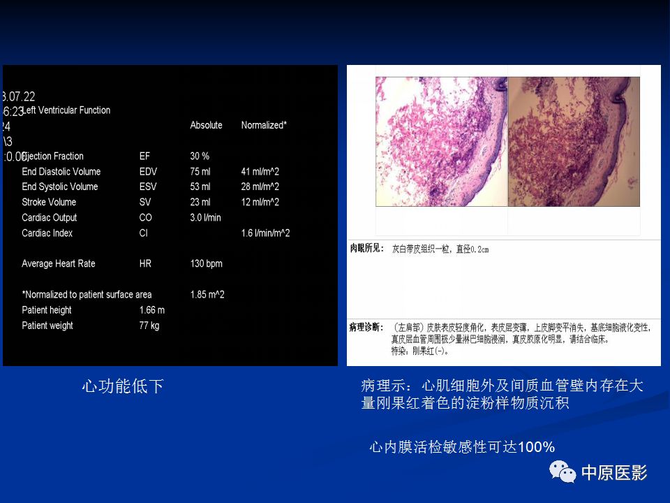 影像PPT - 【病例】心肌淀粉样变性1例MR影像-7