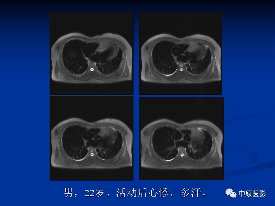 影像PPT - 【病例】心肌淀粉样变性1例MR影像-13