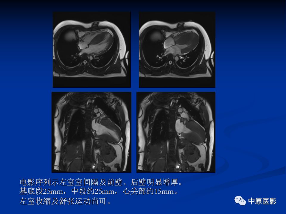 影像PPT - 【病例】心肌淀粉样变性1例MR影像-14