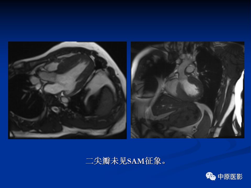 影像PPT - 【病例】心肌淀粉样变性1例MR影像-15