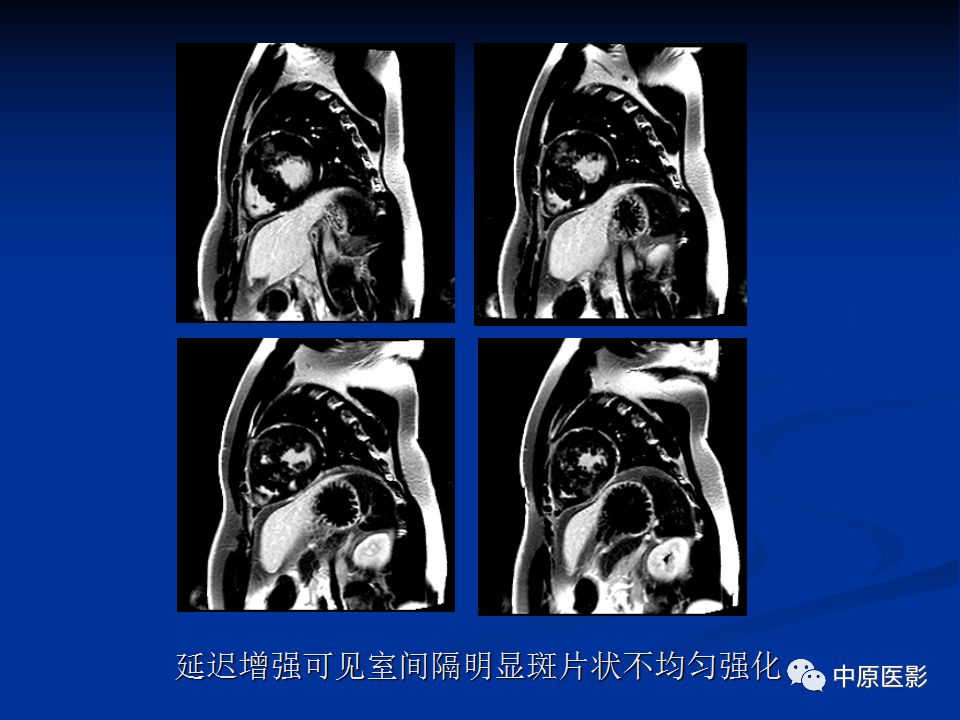影像PPT - 【病例】心肌淀粉样变性1例MR影像-17