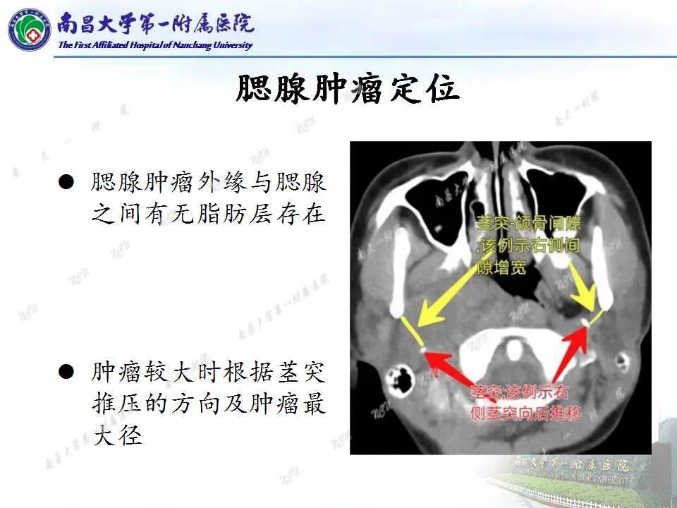 影像PPT - 【PPT】腮腺肿瘤CT诊断分析思路-8