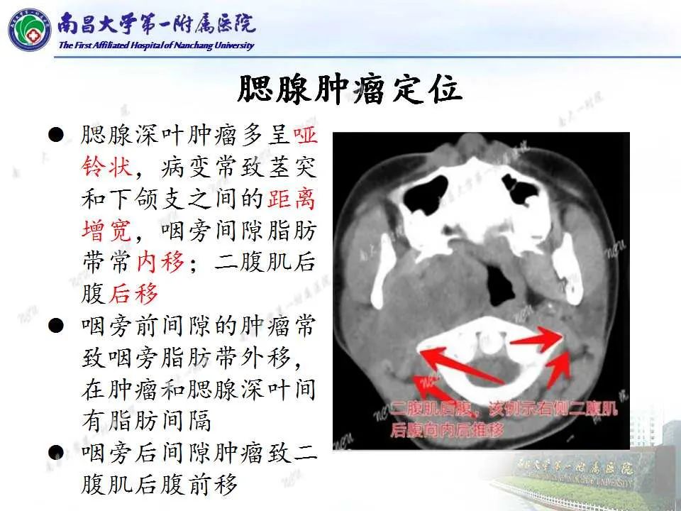 影像PPT - 【PPT】腮腺肿瘤CT诊断分析思路-10