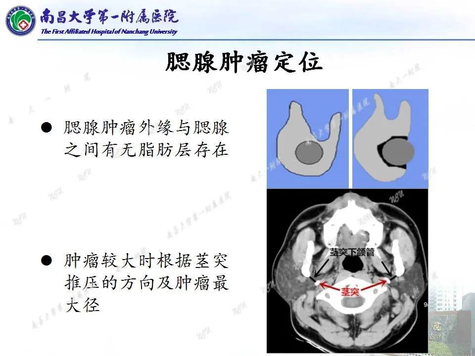 影像PPT - 【PPT】腮腺肿瘤CT诊断分析思路-7