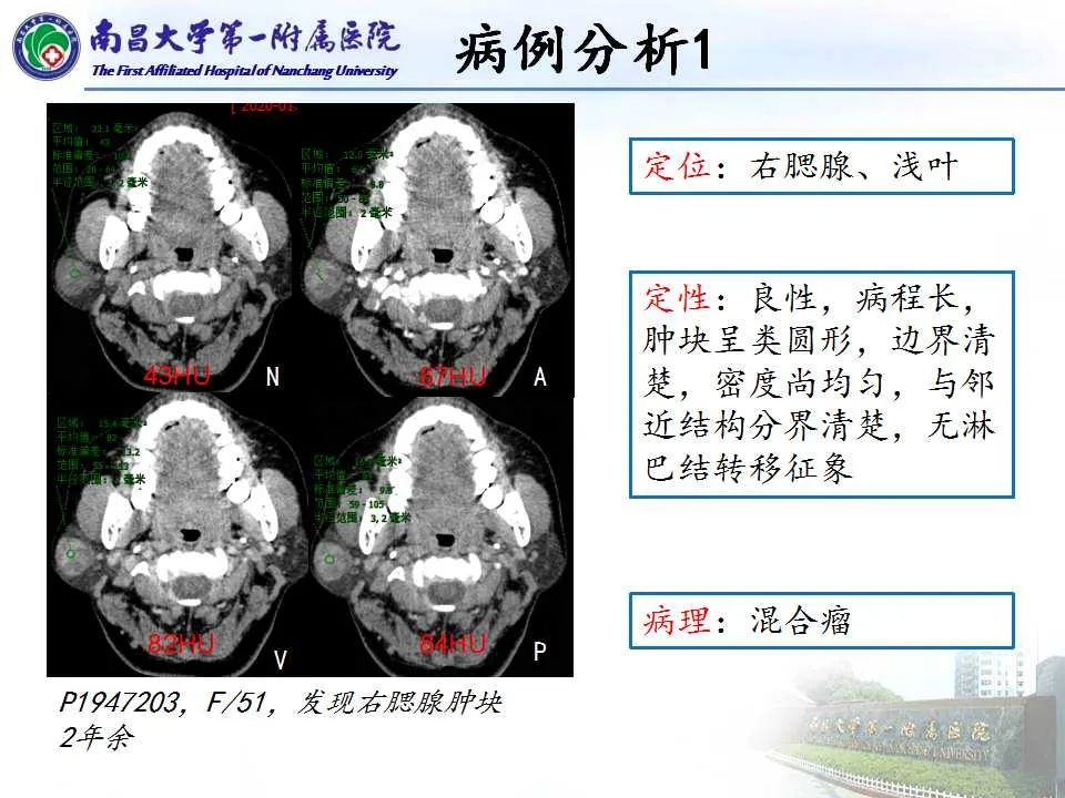 影像PPT - 【PPT】腮腺肿瘤CT诊断分析思路-18